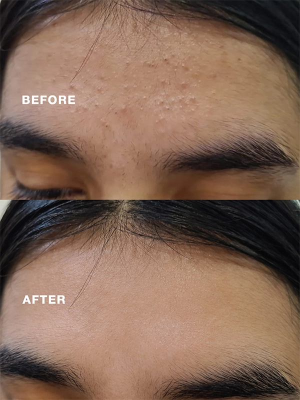 Before After Result